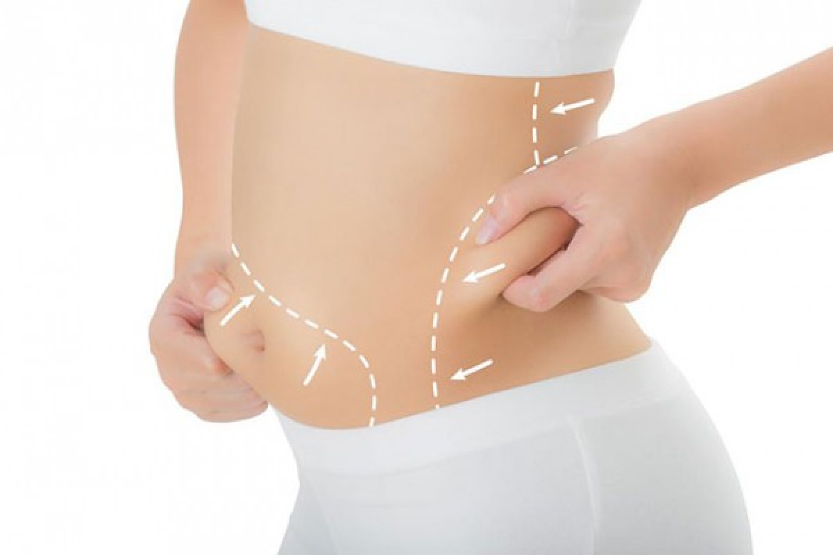 Thị trường dịch vụ hút mỡ - Xu hướng đang lên trong ngành thẩm mỹ